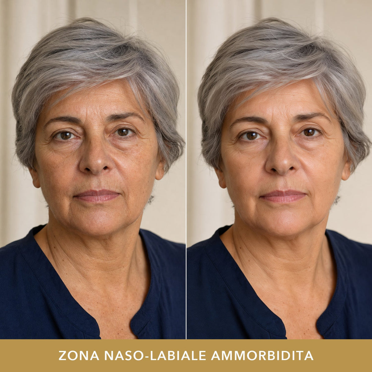 Zona naso-labiale ammorbidita: prima e dopo