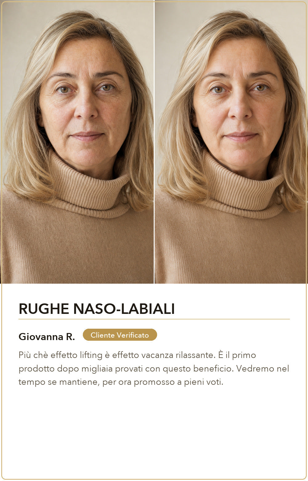Rughe naso labiali